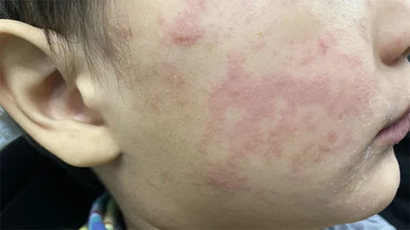 Three measles cases in Delta, first since 1989